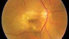 A Refillable Eye Implant Is Approved in the EU for Wet AMD